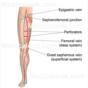 Vulvar Varicose Veins - Important Facts About Varicose Veins You Should Know