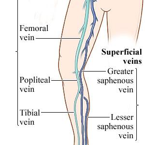 Removal Varicose Vein - Different Types Of Varicose Veins You Should Know About