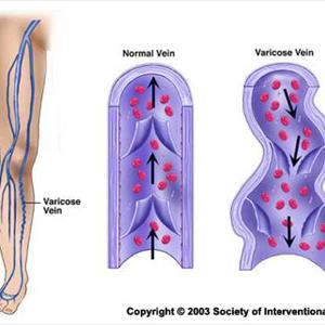 Varicose Stocking - Detailed Information On Varicose Veins