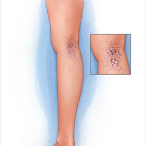  Discussion Of Varicose Veins And FAQ