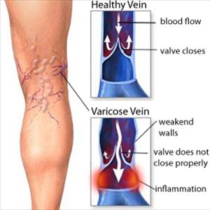 Venus Varicose Veins - Information On Klippel Trenaunay Syndrome