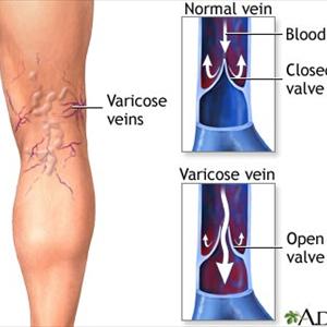 Varicose Man - Varicose Veins: Causes & Prevention