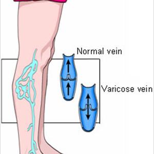 Varicose Veins Anatomy - Varicose Veins Dallas