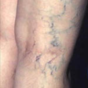 Health Spider Veins - Benefits Of Wearing Medical Compression Stockings
