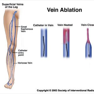 Varicose Veins Venous - Important Facts About Varicose Veins You Should Know