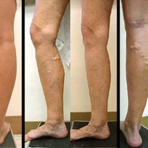 Define Varicose - Benefits Of Wearing Medical Compression Stockings